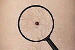 Long Island Tick Spraying